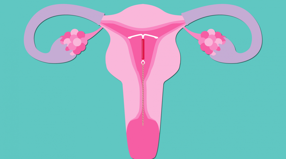 IUDs and Women's Health - Mizan Therapy