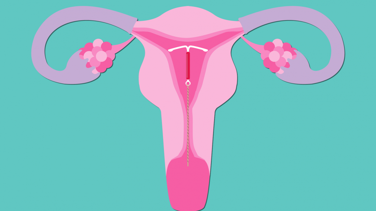 IUDs and Women's Health - Mizan Therapy