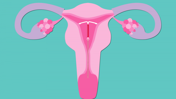 IUDs and Women's Health - Mizan Therapy