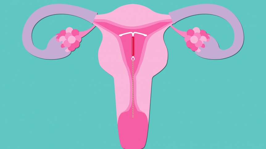 Iuds And Women's Health - Mizan Therapy